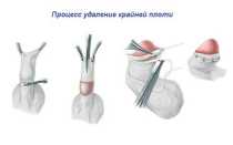 Пластика короткой уздечки полового члена — быстрое и эффективное решение мужских интимных проблем
