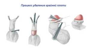 Пластика короткой уздечки полового члена — быстрое и эффективное решение мужских интимных проблем